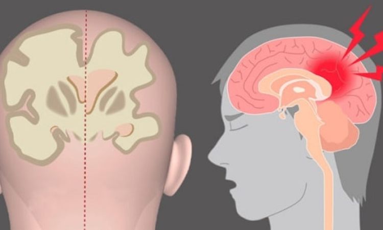 Bệnh teo não là gì? Dấu hiệu nhận biết và hướng điều trị
