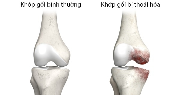 Bệnh thoái hóa khớp có chữa được không?
