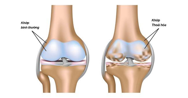 Thoái hóa khớp gối: Nguyên nhân, triệu chứng, điều trị và phòng ngừa