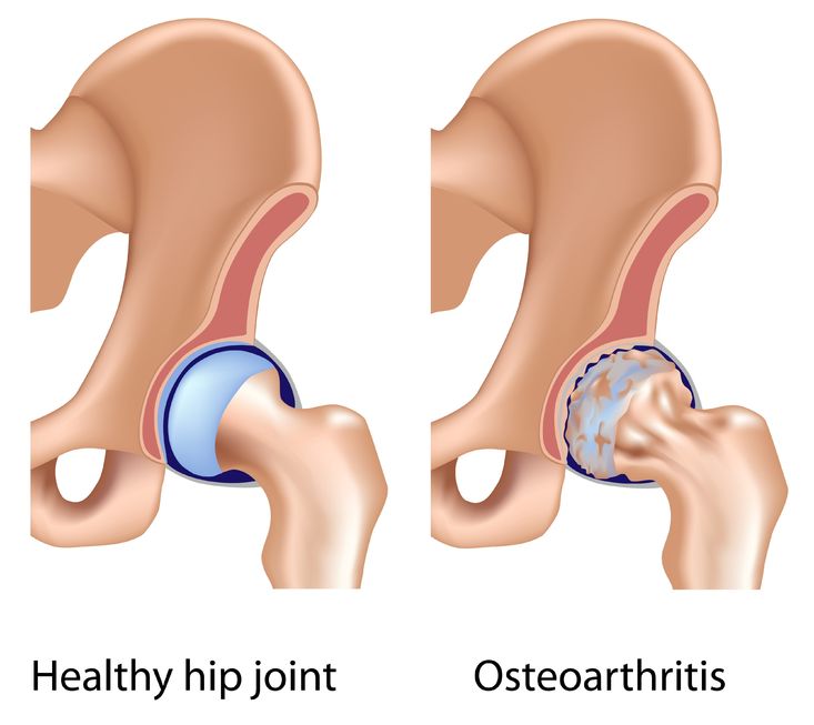 Thoái hóa khớp háng: Nguyên nhân, triệu chứng và cách điều trị