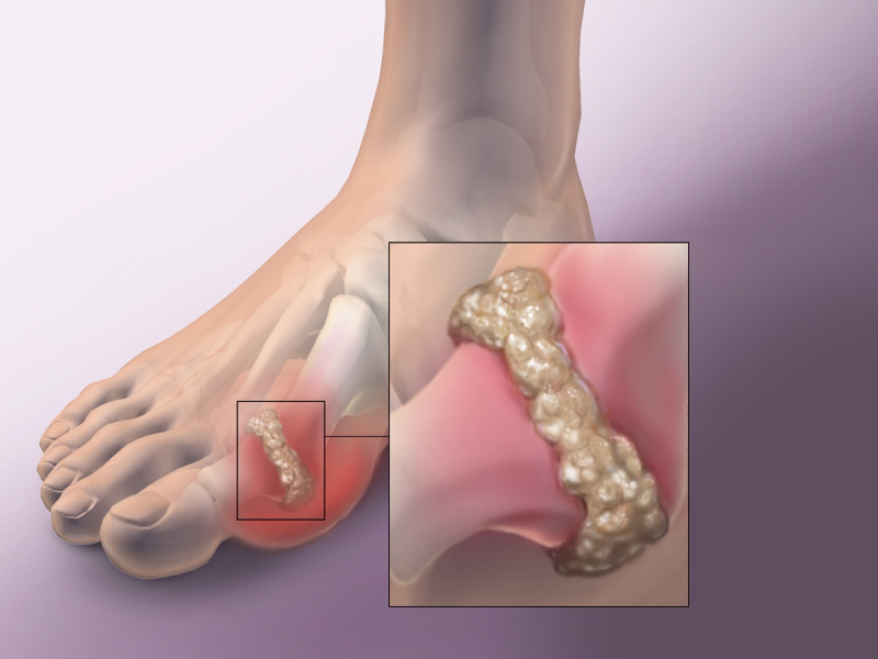 Thống phong là gì? Nguyên nhân, triệu chứng, chẩn đoán và điều trị