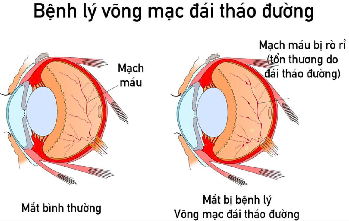 Tiểu đường biến chứng sang mắt: Nguy cơ và cách phòng tránh