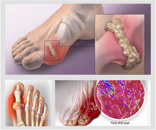 Tinh thể urat trong bệnh gout là gì? Nguyên nhân, triệu chứng và phương pháp điều trị