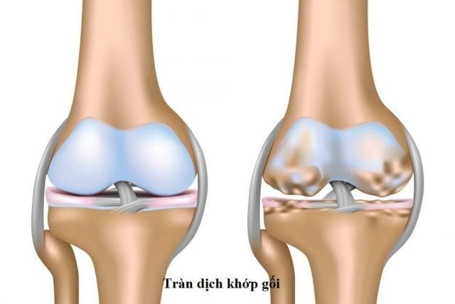 Tràn dịch khớp gối: Nguyên nhân, triệu chứng và cách điều trị