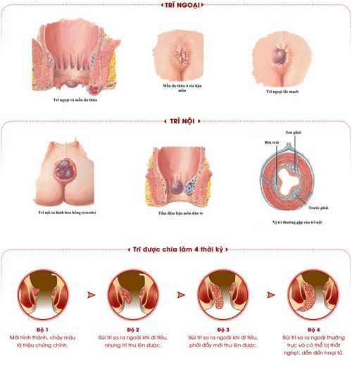 BỆNH TRĨ CÓ MẤY CẤP ĐỘ? HƯỚNG DẪN NHẬN BIẾT VÀ ĐIỀU TRỊ