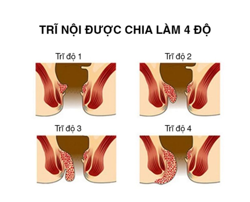 Bệnh Trĩ Có Tự Hết Không? Thời Gian Kéo Dài và Cách Phòng Ngừa Hiệu Quả