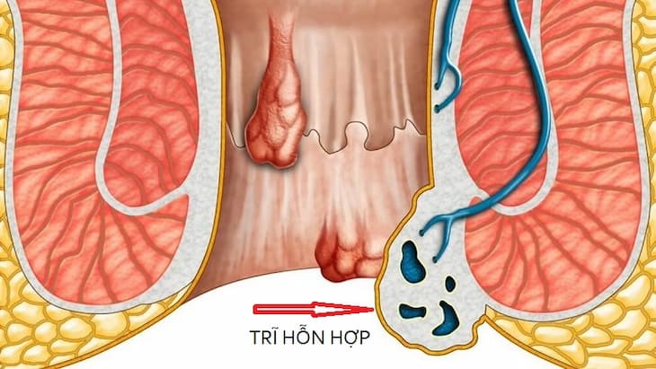 Bệnh Trĩ Hỗn Hợp: Triệu Chứng, Nguyên Nhân, Biến Chứng và Phương Pháp Điều Trị