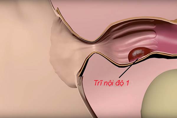 Bệnh Trĩ Độ 1: Nguyên Nhân, Triệu Chứng và Cách Điều Trị