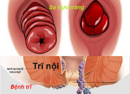 Phân biệt bệnh trĩ và sa trực tràng: Hiểu đúng để điều trị hiệu quả