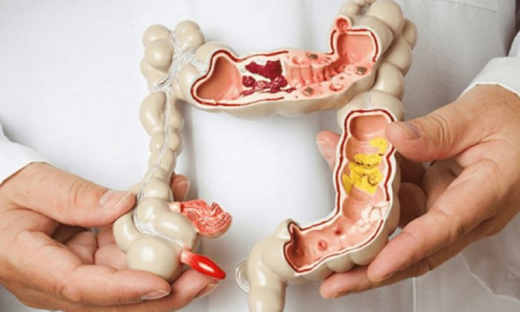 Phân biệt trĩ nội trĩ ngoại – Nhận biết để điều trị hiệu quả