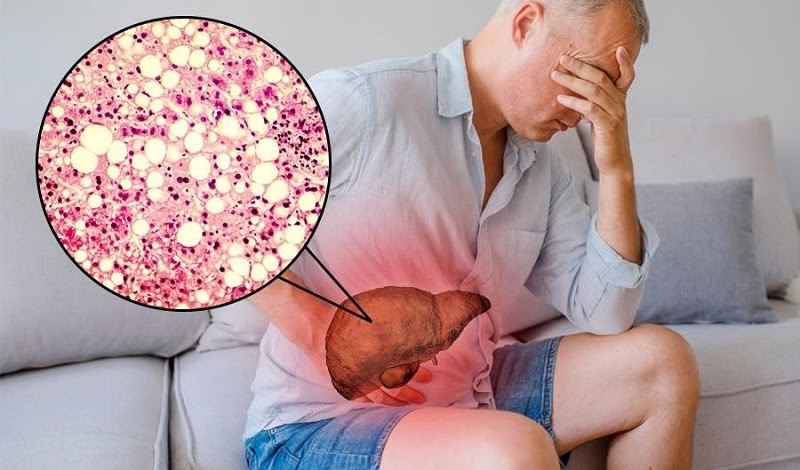 Triệu Chứng Men Gan Cao: Nguyên Nhân, Dấu Hiệu và Cách Phòng Ngừa