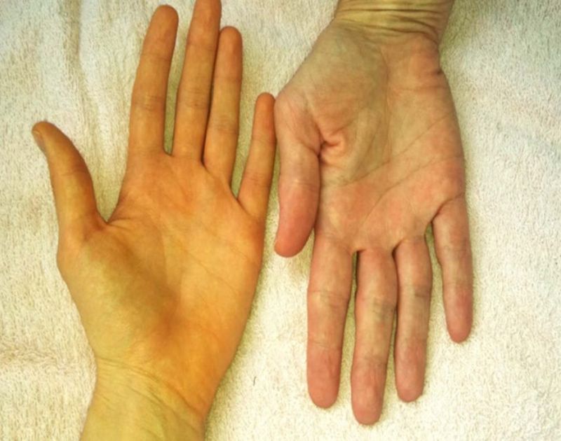 Vàng da ở người lớn là do bệnh gì? Có phải bệnh gan, mật?