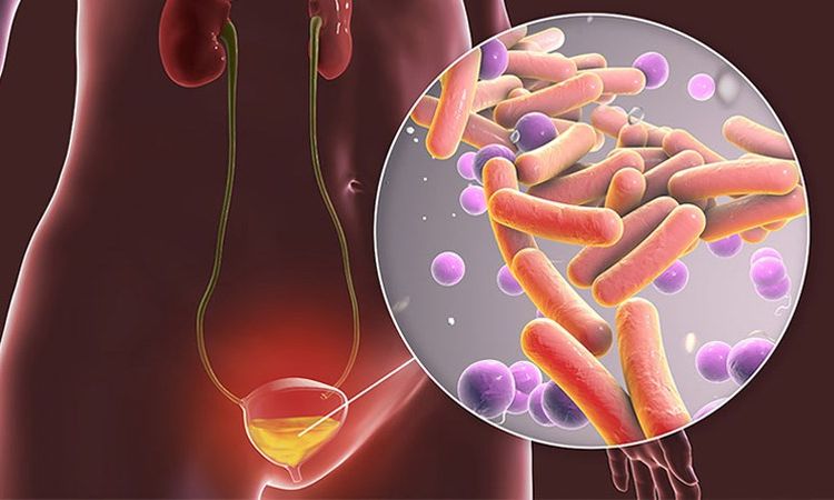 Viêm bàng quang: Nguyên nhân, triệu chứng, điều trị và phòng ngừa chi tiết