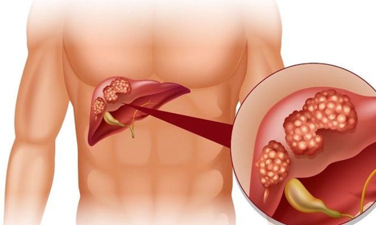 Viêm gan C có chữa được không? Triệu chứng và giải pháp phòng ngừa an toàn