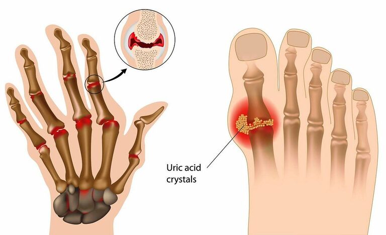 Phân biệt Gút và Viêm khớp dạng thấp