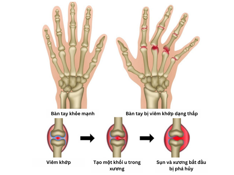 Viêm khớp dạng thấp: Nguyên nhân, triệu chứng, chẩn đoán và điều trị