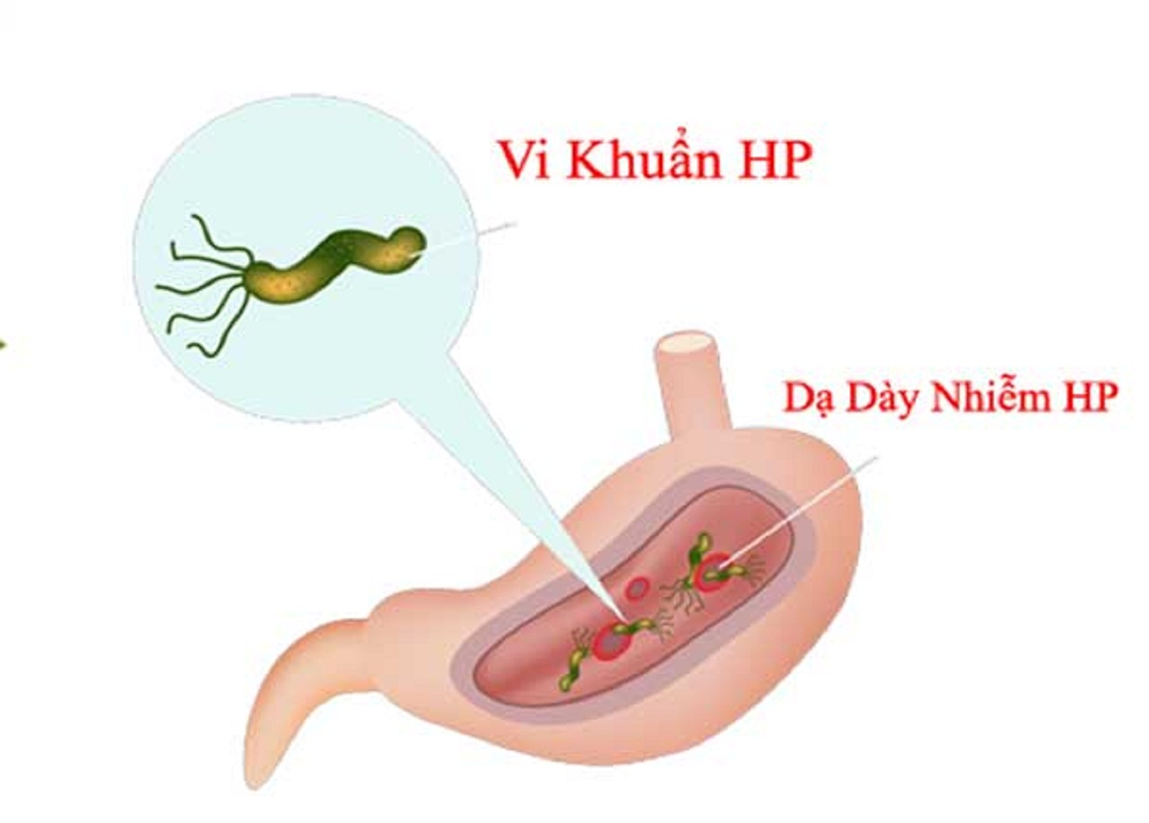 Viêm loét dạ dày do vi khuẩn hp