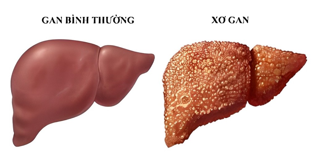 Xơ Gan Có Lây Không? Nguyên Nhân, Đường Lây và Cách Phòng Tránh