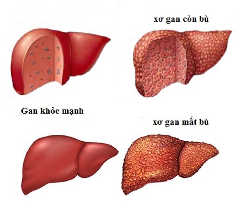 Phân biệt xơ gan còn bù và xơ gan mất bù: Hiểu rõ để phòng ngừa và điều trị