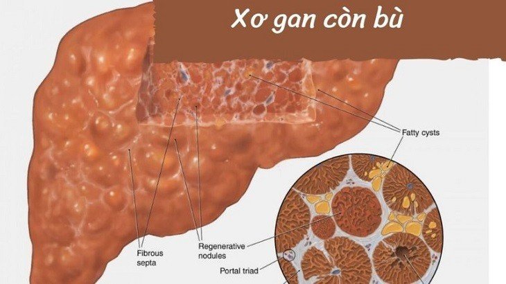 Xơ Gan Còn Bù: Hiểu Đúng Để Bảo Vệ Sức Khỏe Gan