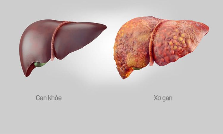 Xơ gan là gì? Bệnh xơ gan có chữa được không?