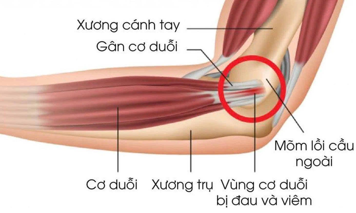 Đau khớp khuỷu tay: Nguyên nhân, triệu chứng và cách điều trị