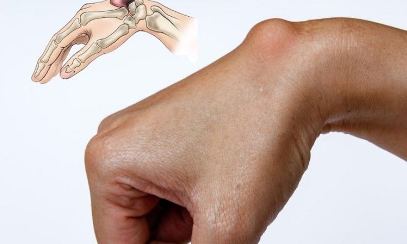 Viêm bao hoạt dịch khớp là gì?