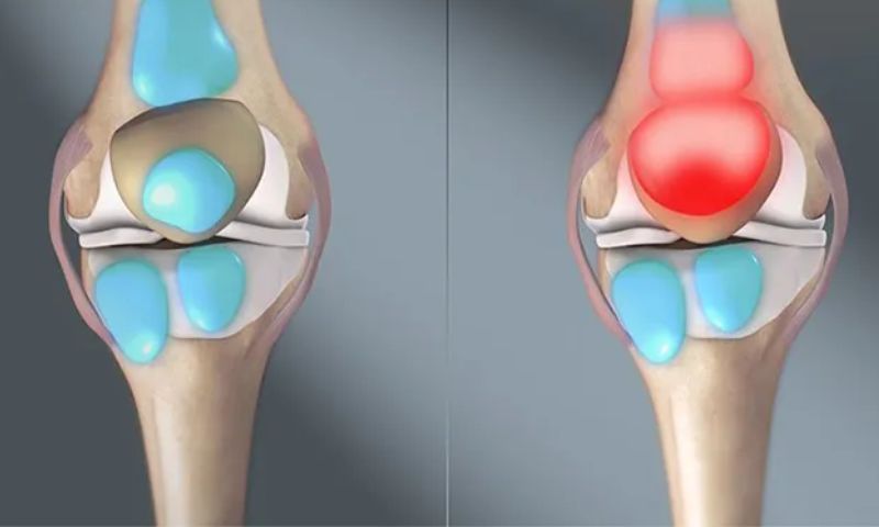 Chẩn đoán viêm bao hoạt dịch khớp