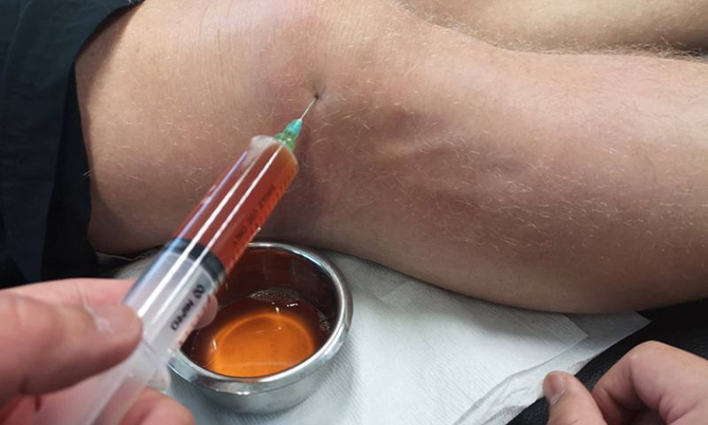 Bệnh lý liên quan đến hoạt dịch
