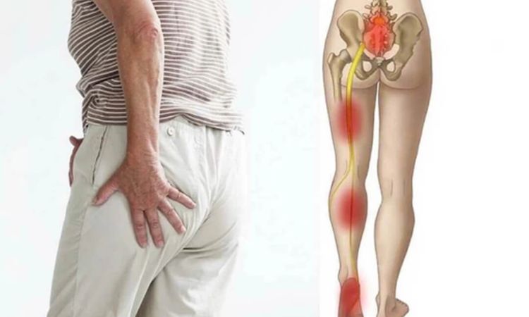 Đau dây thần kinh tọa