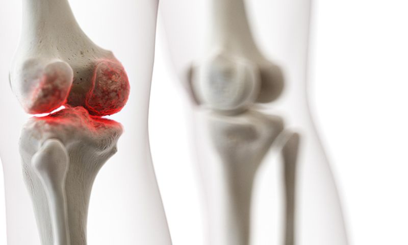 Nguyên nhân khô khớp