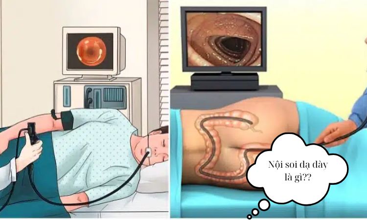 Nội soi dạ dày là gì?