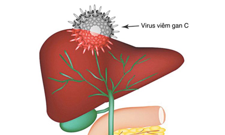 Viêm gan C lây qua đường nào