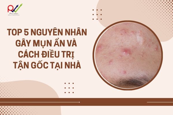 Top 5 Nguyên Nhân Gây Mụn Ẩn Và Cách Khắc Phục Tận Gốc Tại Nhà