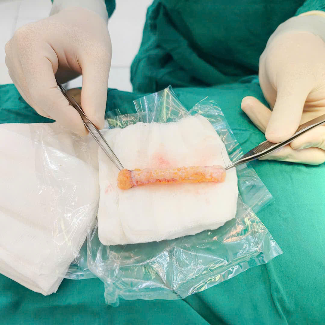 Cấy trung bì mũi