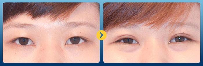 Cắt mí có an toàn không? Tìm hiểu từ A Đến Z