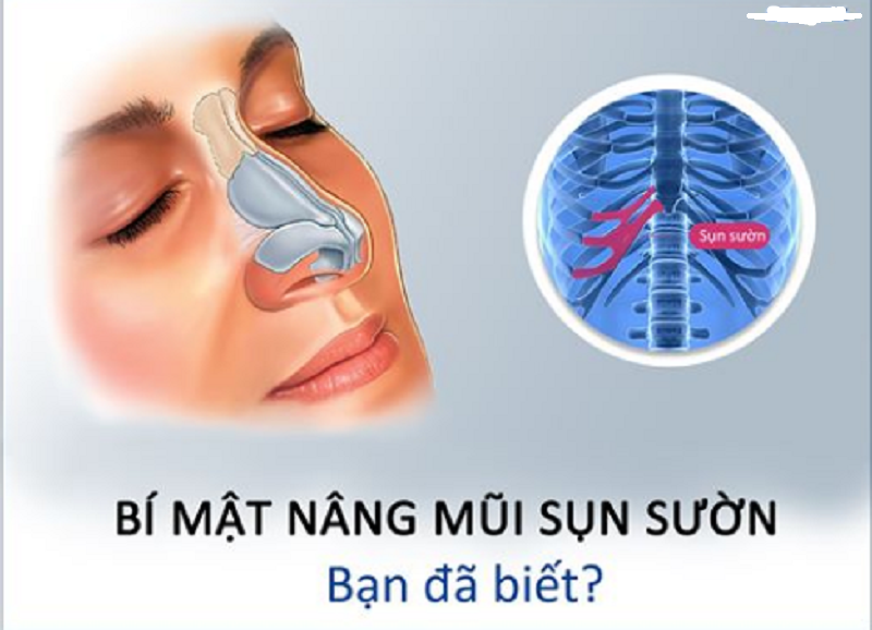 Nâng Mũi Sụn Sườn