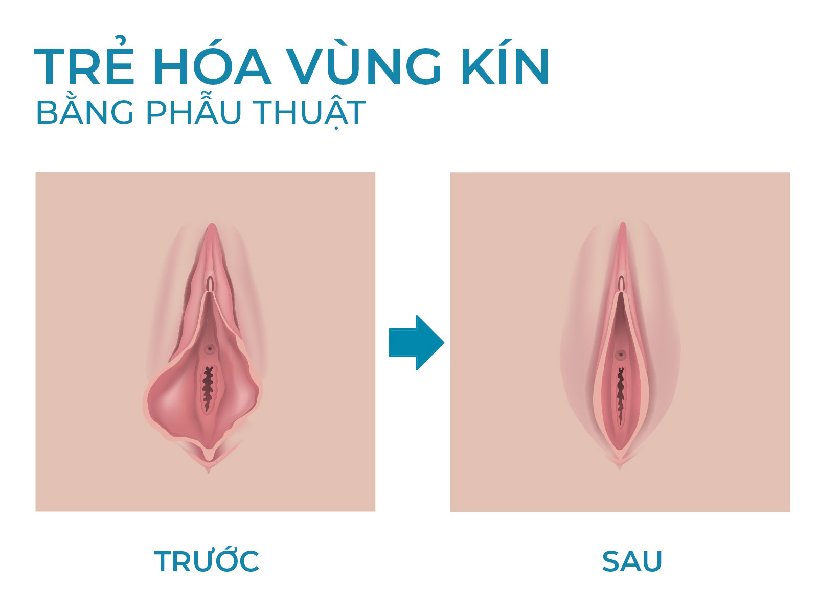 Thu hẹp âm đạo