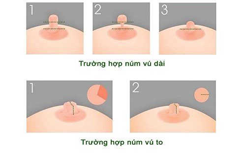 Thu nhỏ núm vú