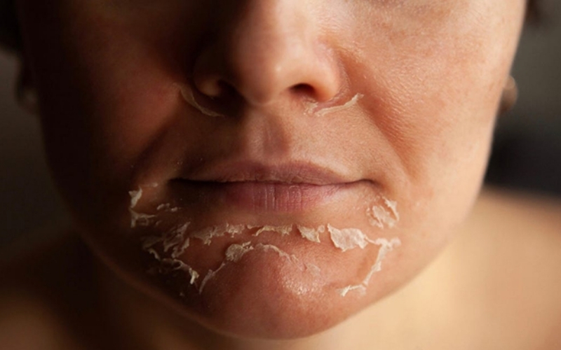 Khi cơ thể thiếu hụt các vi chất thiết yếu, làn da thường là một trong những cơ quan đầu tiên phản ánh sự mất cân bằng đó