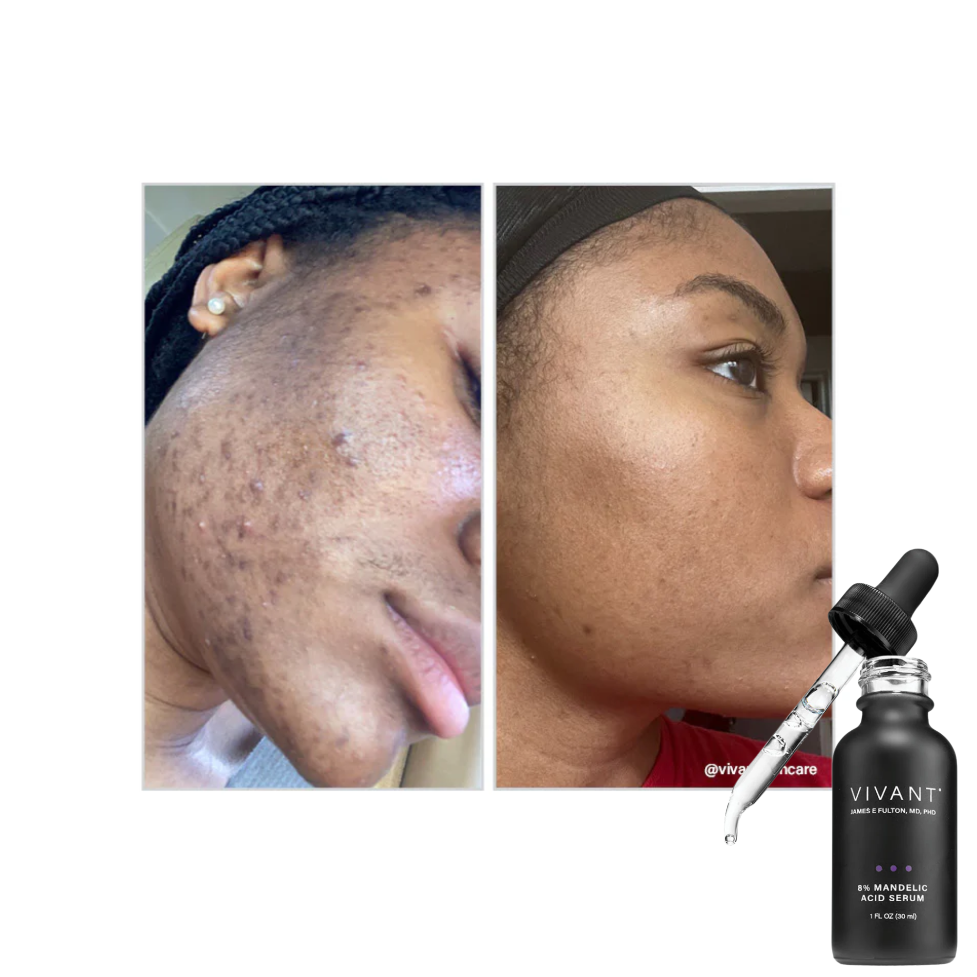 Vivant Skincare 8% Mandelic Acid - Serum Tái Tạo Da Chuyên Sâu Cho Làn Da Sáng Mịn, Sạch Mụn Chuẩn Y Khoa