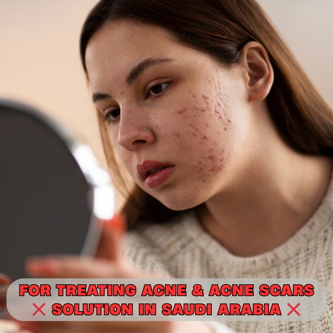 Best Acne & Acne Scar Treatment in  Saudi Arabia – Safe & Fast Effective