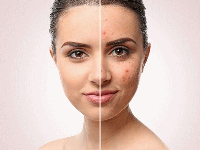 CAUSES OF ACNE AND EFFECTIVE SOLUTIONS ?