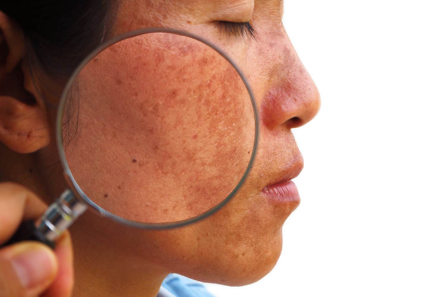 HOW TO PREVENT MELASMA CAUSED BY SUNLIGHT