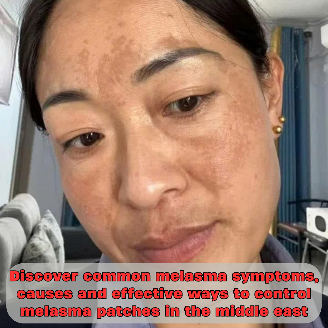 Melasma Symptoms: How to Recognize and Manage Them