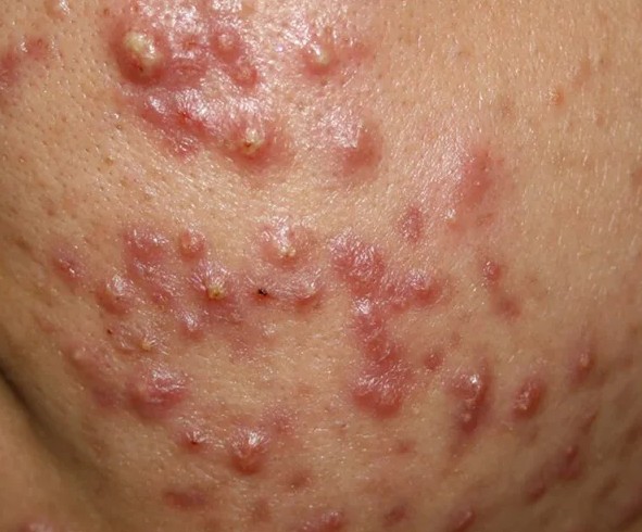 Best Acne Treatment in Saudi Arabia ( Riyadh ) - Safe and Fast Effect