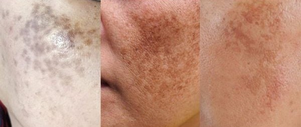Top Melasma Treatment in UAE ( Dubai , Abu Dhabi, Sharjah ) – Fast Results & Safe Solutions