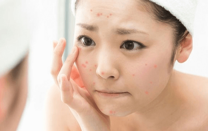 Steps to Take Care of Acne-Prone Skin