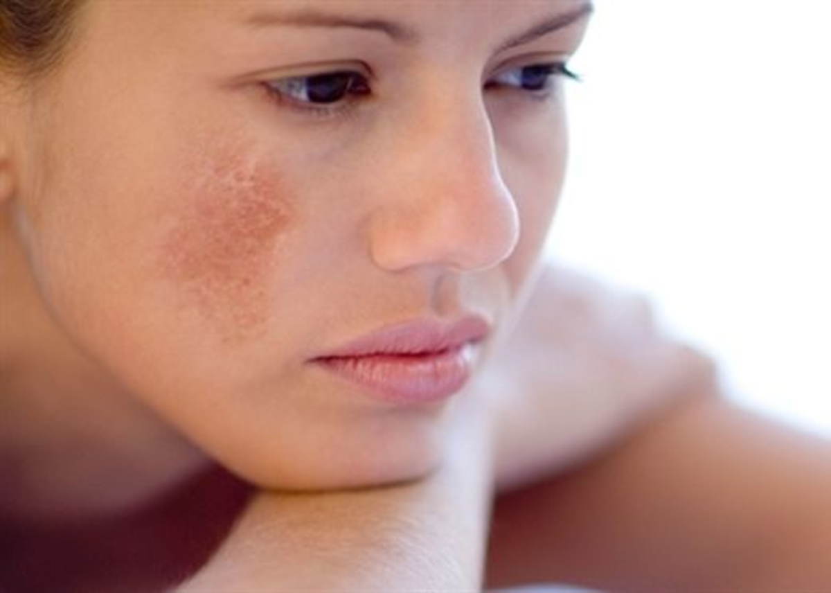 The Perfect Solution To Eliminate Melasma