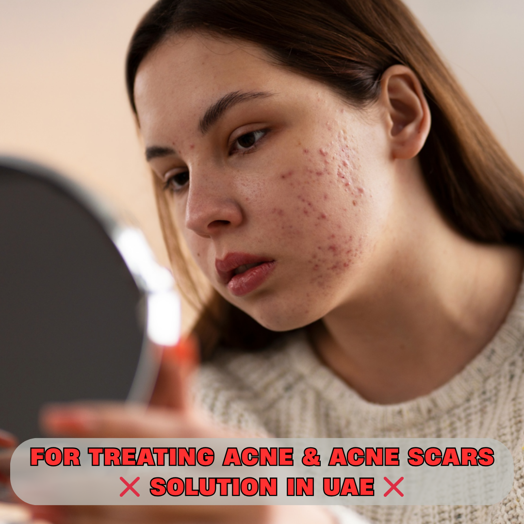 Best Acne & Acne Scar Treatment in UAE – Safe & Fast Effective